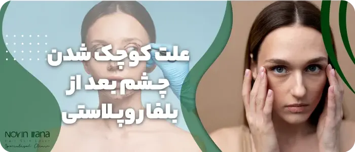 علت کوچک شدن چشم بعد از بلفاروپلاستی